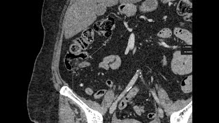 Lipomatosis of the ileocecal valve [upl. by Falkner493]