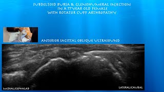 Ultrasound Guided Subdeltoid Bursa Glenohumeral injection in a Female with Rotator Cuff Arthropathy [upl. by Collbaith572]