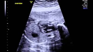 Tetralogy of Fallot with pulmonary stenosis overview [upl. by Ainud530]