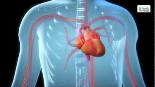 Angioplasty Procedure Animation Video [upl. by Retlaw]