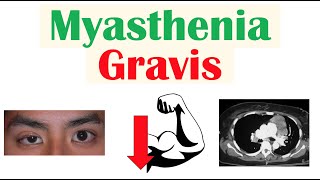 Myasthenia Gravis  Pathophysiology Signs amp Symptoms Diagnosis Treatment [upl. by Benedict544]