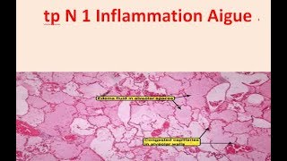 TP ANAPATHInflammation aiguë [upl. by Rizan]