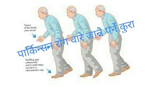 Parkinsons in NepaliDr Bhupendra Shah [upl. by Lose]