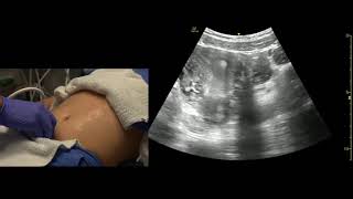 Transabdominal Pelvis Ultrasound Scanning Techniques [upl. by Ingunna]