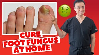 6 Effective HOME REMEDIES To CURE Toenail FUNGUS  Holistic Toenail Fungus Cures Part 2  Dr Kim [upl. by Gnik]