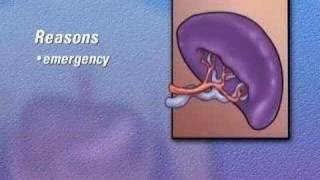 PreOp® Patient Education Spleen Laparoscopic Splenectomy [upl. by Ebsen472]