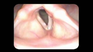 Vocal cord paralysis with nodules [upl. by Volnak]