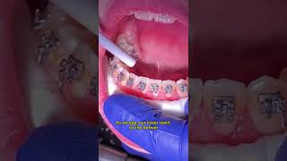 What is a permanent retainer in braces Toothtime New Braunfels Dentist  Braces journey [upl. by Nhguavahs]