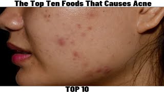 The Top Ten 10 Foods That Causes Acne [upl. by Macswan907]