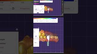 ExocadFirst premolar implant design digitaldentistrywzsamee7 takedigitalstep dentaltechnology [upl. by Etnoel897]