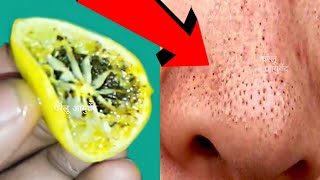 सर्फ 5 मिनट में ब्लैकहेड्स और वाइटहेड्स खत्म करें blackheads amp whiteheads remove fast in 5 minutes [upl. by Acenahs]