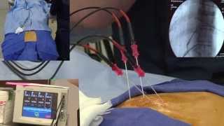 Radiofrequency Ablation Explanation Video Demonstration  LIVE [upl. by Nodal]