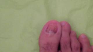 TOENAIL FUNGUS DOCUMENTARY DAY 15 [upl. by Pinelli740]