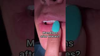 Braces off  Mamelons after braces  Tooth Time Family Dentistry New Braunfels [upl. by Merrie]