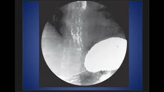 Case Discussion  Esophageal Varices [upl. by Enitsugua]