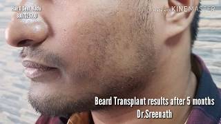 Patchy Beard  Filling by Micro FUE  5 months results  DrSreenath Kochi Kerala India [upl. by Marler]