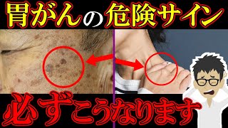 放置厳禁！胃がんの危険な症状5選！○○な人リスク6倍・・・【胃癌｜ガン｜悪性新生物｜胃潰瘍｜原因】 [upl. by Aundrea627]