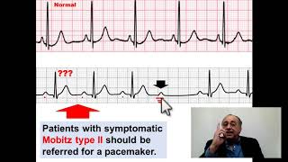 Mobitz type II AV Block cme internalmedicine pharmaceutical medical doctor محاضراتباطنة [upl. by Onidranreb]