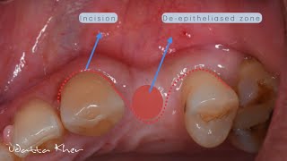 Buccal Roll Flap [upl. by Parrnell]