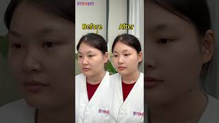 Notice the amazing skin and body transformation 😍 CavitationMachine FacialDevice AntiAging [upl. by Nomahs908]