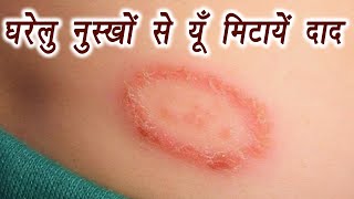 Ringworm infection Home Remedies  दाद के लिए करें यें घरेलू उपाय  Boldsky [upl. by Ariet185]