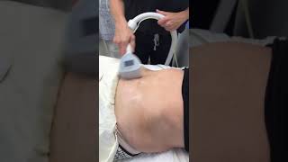 Exilis Skin Tightening  Exilis Ultra  Oceanside Aesthetics [upl. by Yzzo]