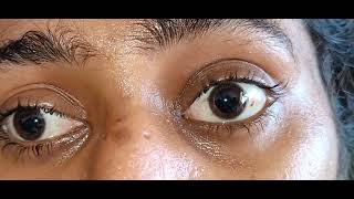 Complete Bilateral Ophthalmoplegia Video [upl. by Eizus]