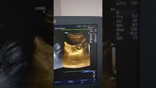 Hemorrhagic Cyst in Lt Ovary Ultrasound [upl. by Hyps]