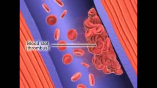 Formation of Deep Vein Thrombosis [upl. by Ladnar]