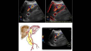 Medical imaging Recanalized round ligament Portal hypertension Liver [upl. by Drofxer448]