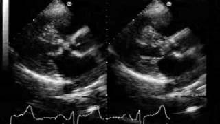 fixed subaortic stenosis in atrioventricular canal defect [upl. by Annoya124]