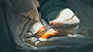 Varicose Vein Surgery Vein Stripping [upl. by Devlin525]