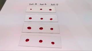 Blood typingRh positive slide agglutination test MEDICAL LABORATORY SCIENCE [upl. by Meri]