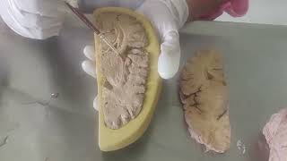 Anatomy of Internal capsule neuroanatomy dissection [upl. by Anuaik]