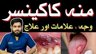 ORAL CANCER  Symptoms  Causes  Treatment  منہ کا کینسر  Urdu  Hindidrmuneermalik [upl. by Deden]