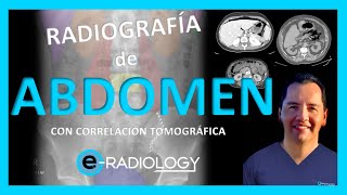 Cómo INTERPRETAR una RADIOGRAFÍA de ABDOMEN  🤔 Todo lo que necesitas saber 💡🚀 [upl. by Paschasia361]