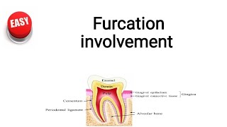 Furcation involvement [upl. by Sherurd]