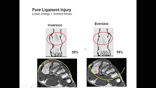 Imaging of Lisfranc Injury [upl. by Mathre]