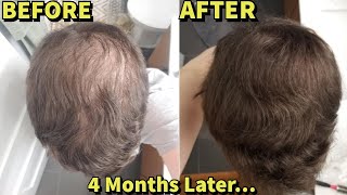 He Was Microneedling WITHOUT FinasterideMinoxidil For 4 MonthsSHOCKING Results [upl. by Naujet748]