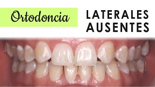 AGENESIA DENTAL  TRATAMIENTOS LATERALES SUPERIORES AUSENTES [upl. by Mortimer]