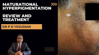 Dark marks on cheeks Maturational hyperpigmentation  review and treatment [upl. by Noll]