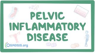 Pelvic inflammatory disease  causes symptoms diagnosis treatment pathology [upl. by Tham]