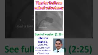 Tips for balloon mitral valvotomy [upl. by Yand]