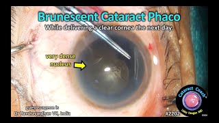 CataractCoach™ 2202 brunescent cataract phaco with a clear cornea the next day [upl. by Fugate]