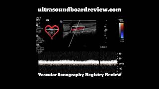 Tardus Parvus Spectral Doppler [upl. by Gewirtz997]