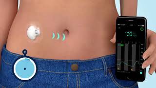 What is Continuous Glucose Monitoring CGM [upl. by Hobey]