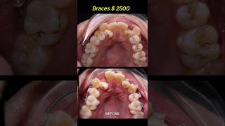 Cost  2500 for this case Braces crooked teeth braces orthodontist dentist [upl. by Ancilin274]