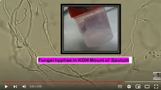 Fungal branched hyphae in KOH mount of Sputum Microscopy [upl. by Amalee874]