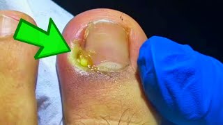 The WORST Infected Toenail Removal Youve Ever Seen [upl. by Aical561]