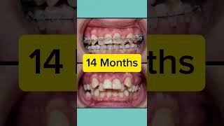 Orthodontics Case 14 Month Restoration [upl. by Ahsienad]